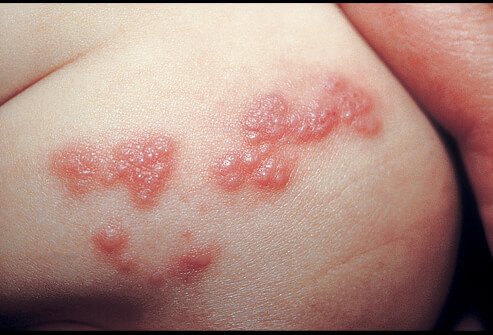 Can Herpes Be Treated? The Essential Things To Do