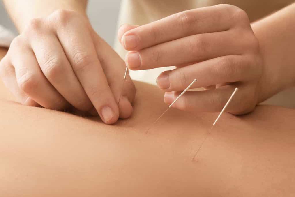 Dry Needling: A Therapeutic Technique for Musculoskeletal Pain Relief